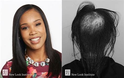 Women's CRLAB Hair Loss Solutions .